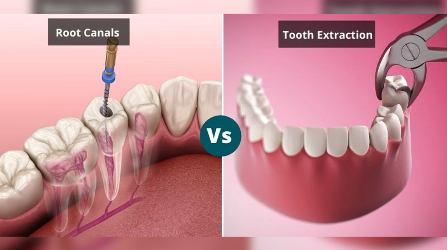 What is the difference between root canal treatment and extraction