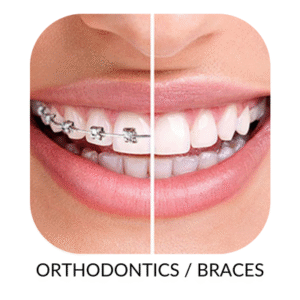 Orthodontics Braces