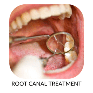 Root canal treatment